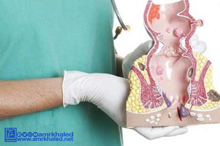 أسهل طريقة لعلاج البواسير